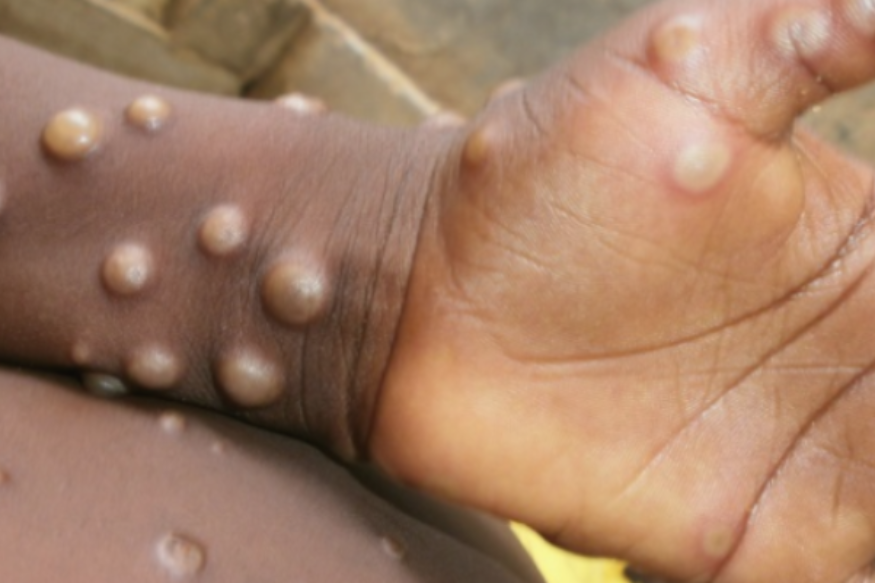 First case of monkeypox virus is confirmed in Wales